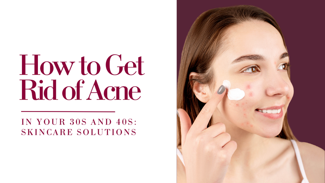 How to Get Rid of Acne in Your 30s and 40s: Skincare Solutions