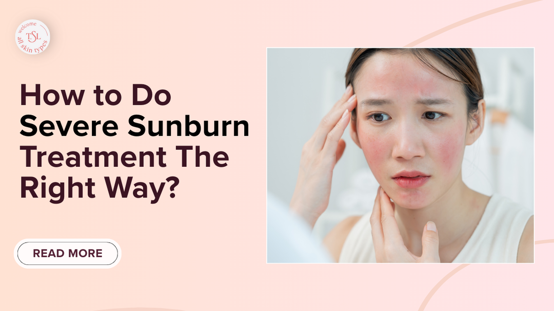 How to Do Severe Sunburn Treatment The Right Way?