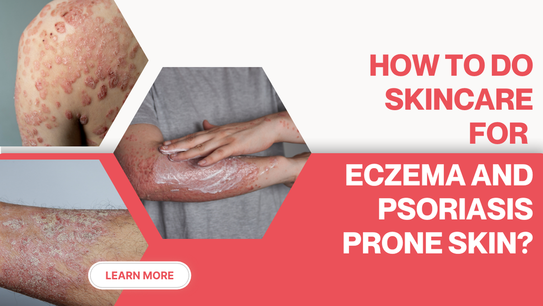 skincare-for-eczema