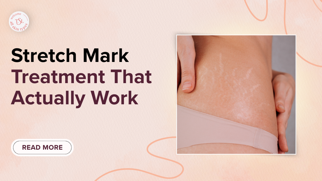 stretch-mark-treatment