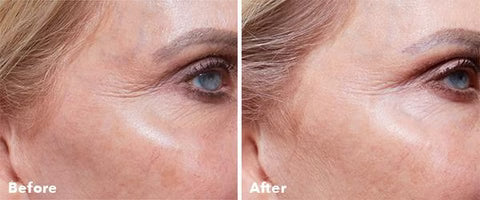 AnteAGE® Home Microneedling Intro Kit